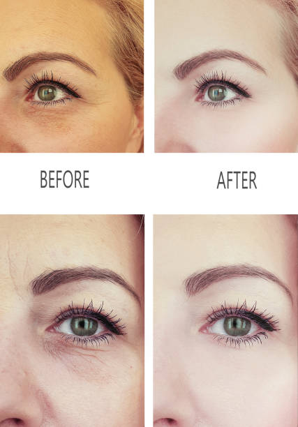 istock woman wrinkles before and after procedures 1138031746