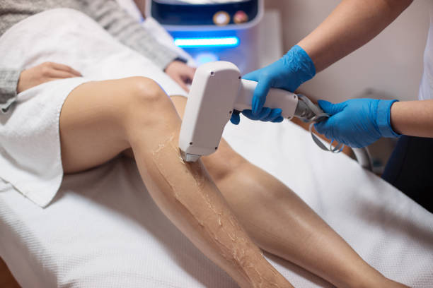 esthéticienne enlevant les cheveux avec l'épilateur de laser - laser photos et images de collection