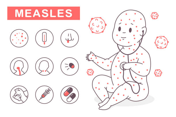 Measles vector infographics. Child character with a rash and icons with symptoms and treatment methods isolated on a white background. Measles vector infographics. measles illustrations stock illustrations