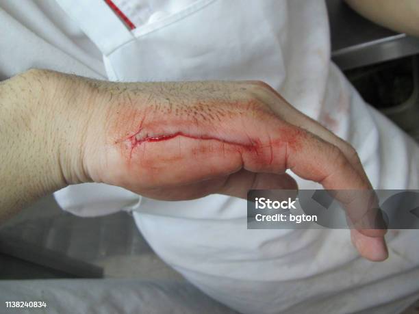 Hand Injury Stock Photo - Download Image Now - Backgrounds, Blood, Dead -  iStock