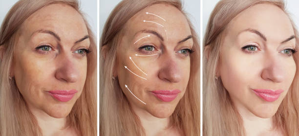 istock woman wrinkles before and after procedures collage 1138259926