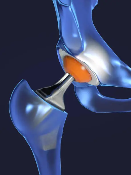 Photo of Function of a hip joint implant or hip prosthesis in frontal view - 3d illustration