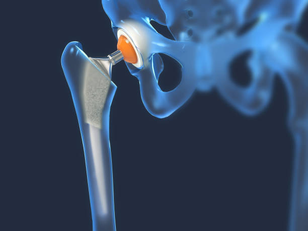 función de un implante articular de cadera o prótesis de cadera en vista frontal-ilustración 3d - artificial metal healthcare and medicine technology fotografías e imágenes de stock