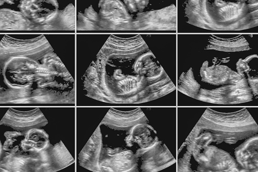 Nine images of fetus ultrasonography.