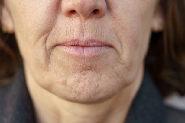 Close up detail of the chin of a middle-aged woman Close up detail of the chin of a middle-aged woman without makeup showing the wrinkles and dimpling of the skin associated with ageing smokers wrinkles stock pictures, royalty-free photos & images