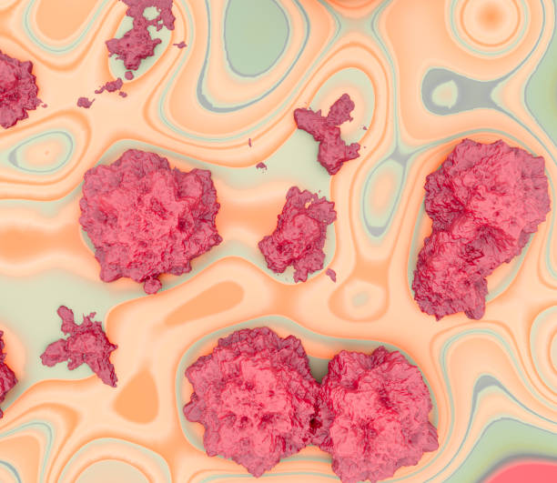 Concept Of A Metastatic Cancer. Malignant (Cancerous) Nodules On Petri Dish stock photo