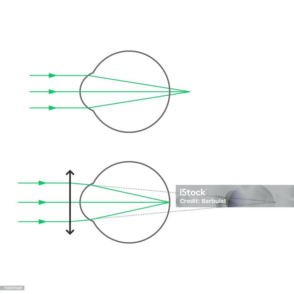 Hyperopia Drawing Hyperopia And Hyperopia Correction With Glasses Stock Illustration ...