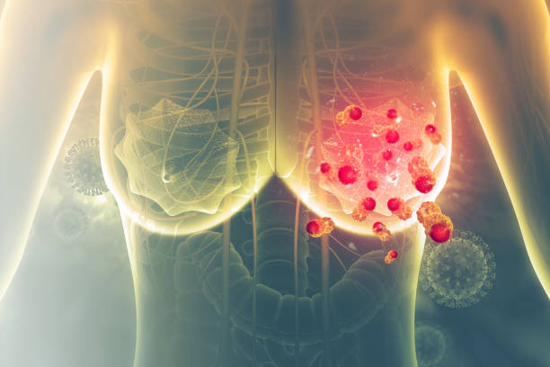 рак молочной железы. 3d иллюстрация - tumor стоковые фото и изображения