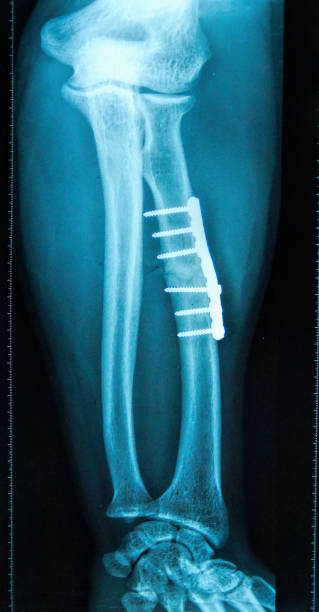Tibia Rot 450+ Tibial Fotografías de stock, fotos e imágenes libres de derechos ...