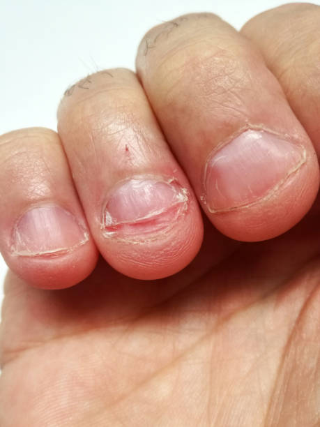 istock tension stress and anxiety causes nail biting finger damage 1138548772