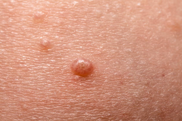 Close up of Molluscum Contagiosum also called water wart Close up of Molluscum Contagiosum also called water wart. wart stock pictures, royalty-free photos & images