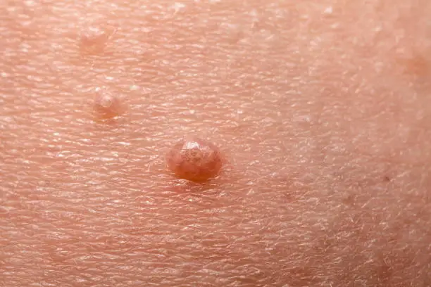 Close up of Molluscum Contagiosum also called water wart.