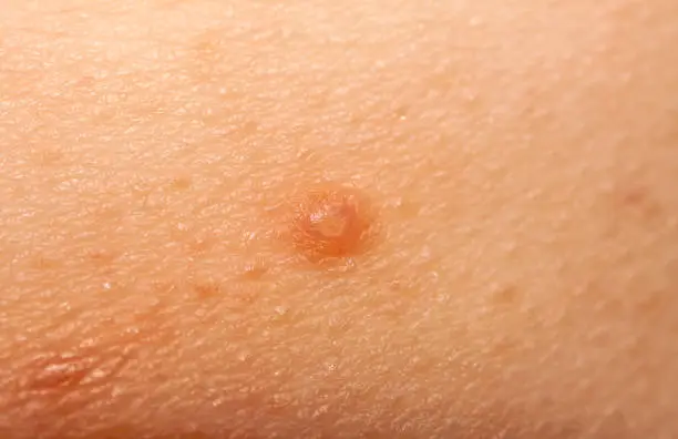 Close up of Molluscum Contagiosum also called water wart.