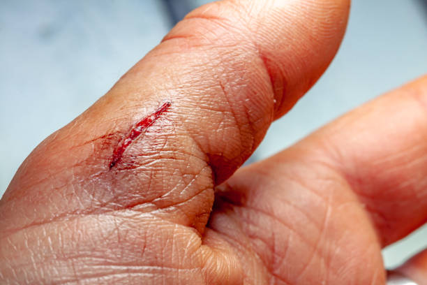 one photo of a series of photos taken of a fresh bleeding cut development over a priod of 90 minutes - wound blood human finger human hand imagens e fotografias de stock
