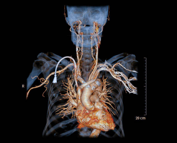 cta 胸部大動脈には、透析患者の場合の骨透過性画像を用いた一般的な頚動脈3d レンダリングが含まれる - brain case ストックフォトと画像