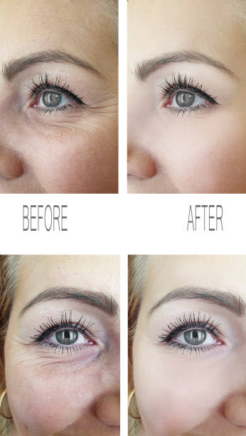 istock woman wrinkles face before and after procedures, removal 1138691707