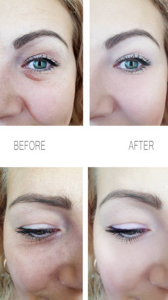 istock woman wrinkles face before and after procedures, removal 1138692594