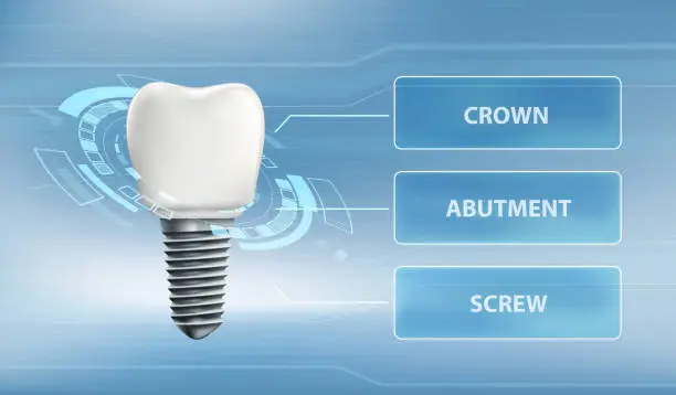 Vector illustration of Dental implant with screw and crown. Technology user interface.