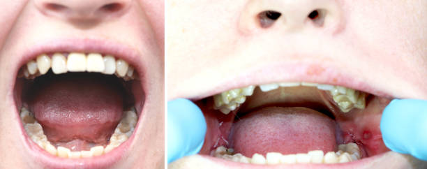 istock Before and after the operation to remove wisdom teeth - eights. Close-up of wisdom teeth and stitches after removing them 1138883762