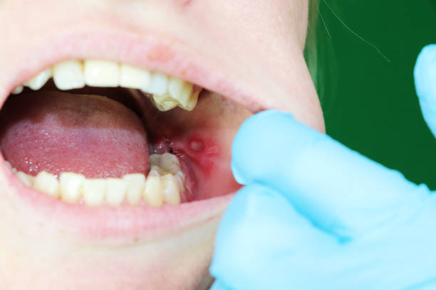 Painful ulcer and stomatitis on the mucous cheek of a girl. After the operation to remove the wisdom teeth. Stitches and postoperative period stock photo