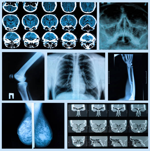 ludzkie kości - x ray chest human lung rib cage zdjęcia i obrazy z banku zdjęć