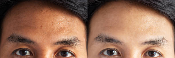 two pictures compared effect Before and After treatment. skin with problems of freckles , pore , dull skin and wrinkles around forehead before and after treatment to solve skin problem for better skin two pictures compared effect Before and After treatment. skin with problems of freckles , pore , dull skin and wrinkles around forehead before and after treatment to solve skin problem for better skin botox before and after stock pictures, royalty-free photos & images
