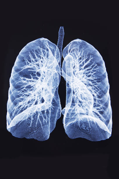 istock X-ray adult body lung scan 1139225477