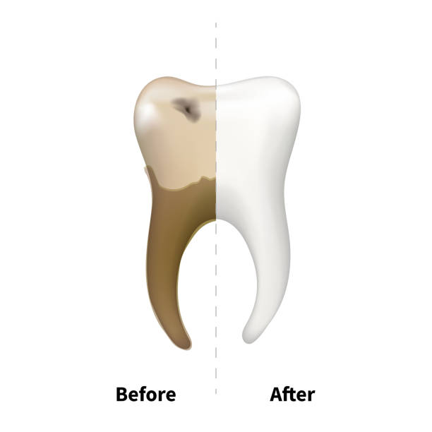 istock Human tooth with old sick side with caries and bright white healthy another, teeth treatment dental concept isolated on white 1139264155