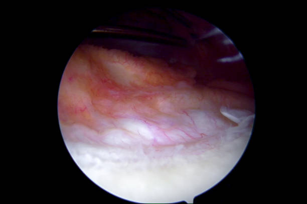 istock Knee arthroscopy showing outflow cannula in suprapatellar recess 1139276559