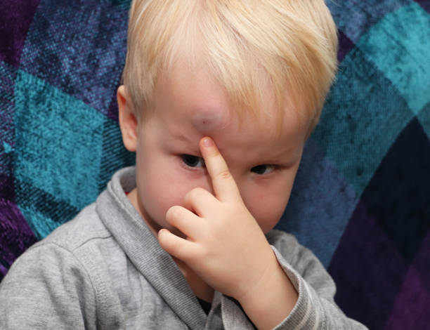 A big bruise on the forehead of a little boy stock photo
