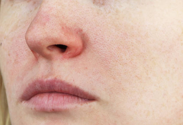 Cuperosis on the nose of a young woman. Acne on the face. Examination by a doctor stock photo