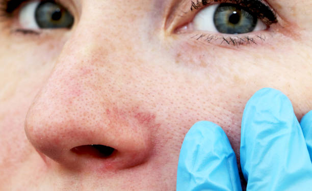 cuperosi sul naso di una giovane donna. acne sul viso. esame da parte di un medico - naso rosso foto e immagini stock