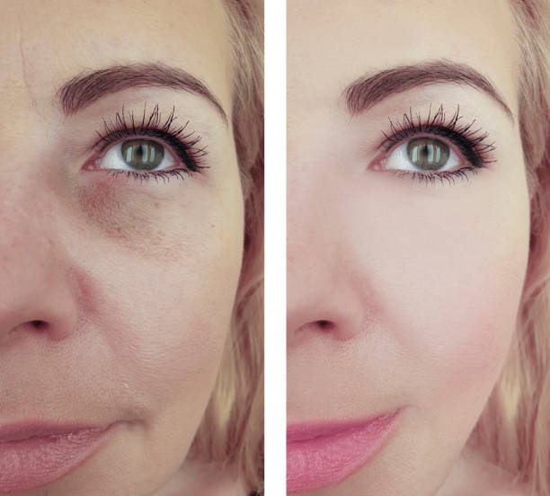 istock woman wrinkles before and after procedures 1139514503
