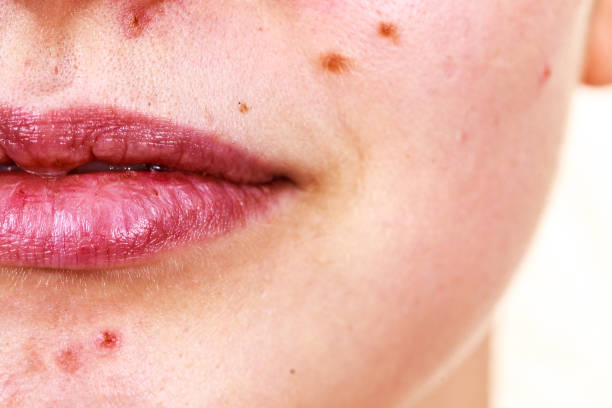 istock Female face with acne skin problem 1139535370