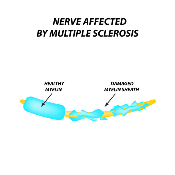 die zerstörung der myelin-hülle auf dem axon. myelin beschädigt. neuron ist von multipler sklerose betroffen. welt-tag der multiplen sklerose. infografiken. vektordarstellung auf isolierten hintergrund. - neuroscience nerve cell nerve fiber dendrite stock-grafiken, -clipart, -cartoons und -symbole