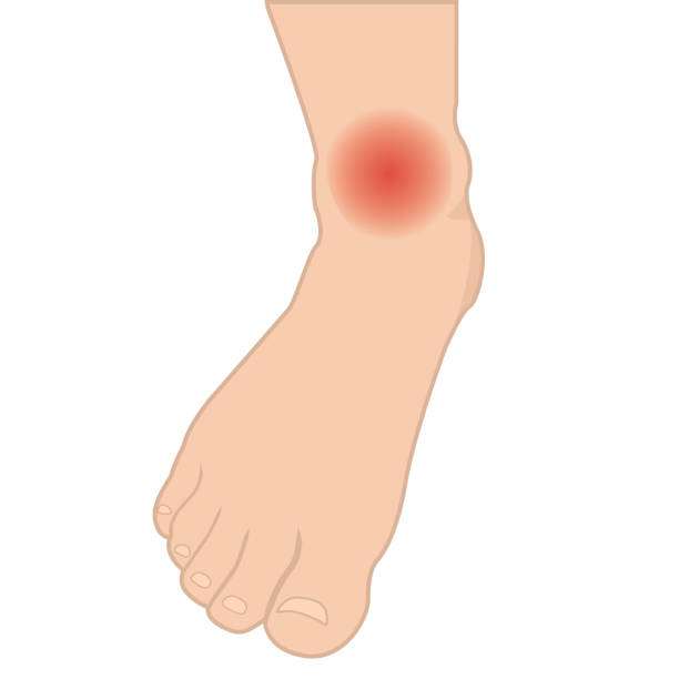 Swelling Of The Feet And Ankles From Infected Or Injury Stock Illustration  - Download Image Now - iStock