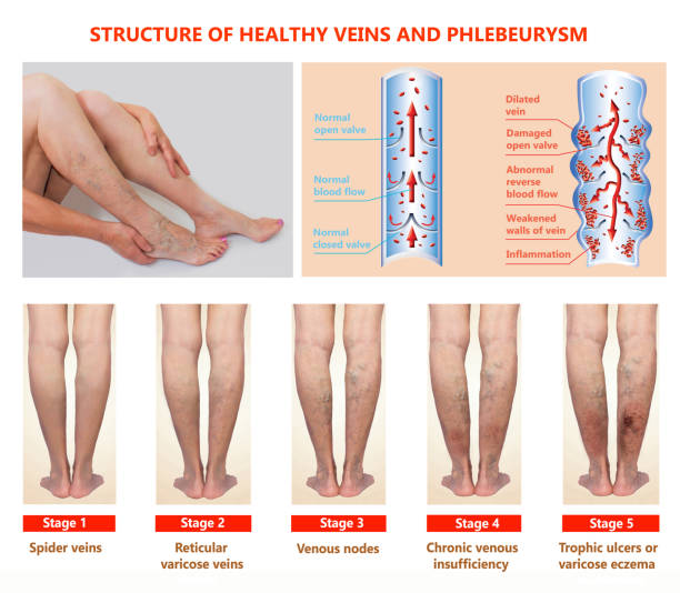 thrombophlébite. thrombose veineuse profonde. varices - venous insufficiency photos et images de collection