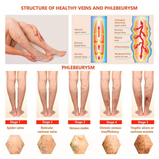 thrombophlébite. thrombose veineuse profonde. varices - venous insufficiency photos et images de collection