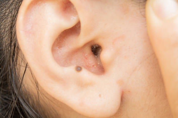 istock Dry skin disease in the ear 1139842617