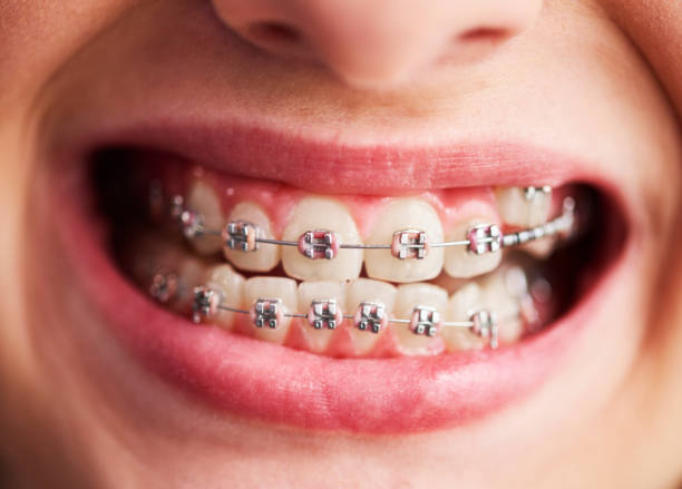 istock Shot of child's teeth with braces 1139842634