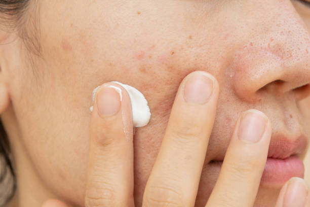 istock Acne scars and pores. Black spots, 1139844879