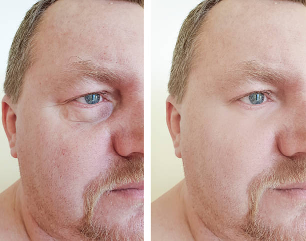 istock man eyes bloating wrinkles before and after procedures 1140075056
