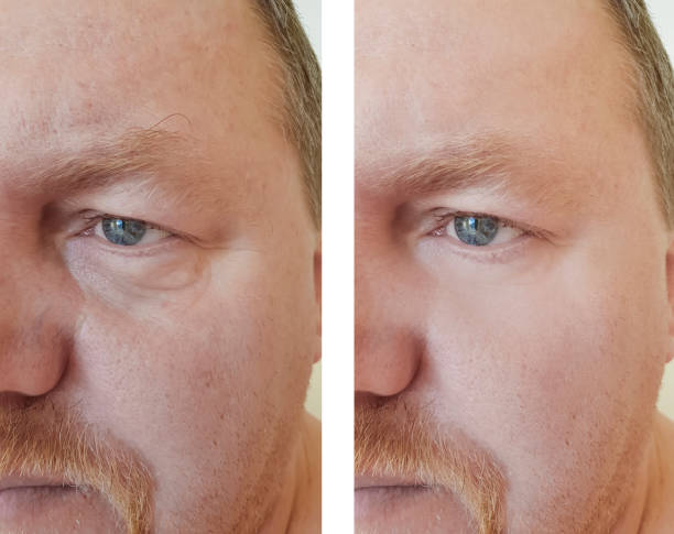 istock man eyes bloating wrinkles before and after procedures 1140075060
