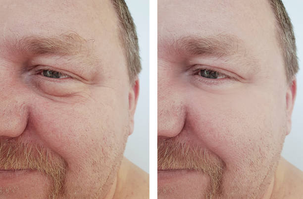 istock man eyes bloating wrinkles before and after procedures 1140075100