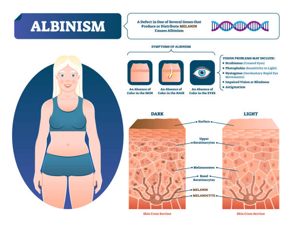 иллюстрация вектора альбинизма. помеченная медицинская схема потери пигмента меланина. - melanocyte stock illustrations