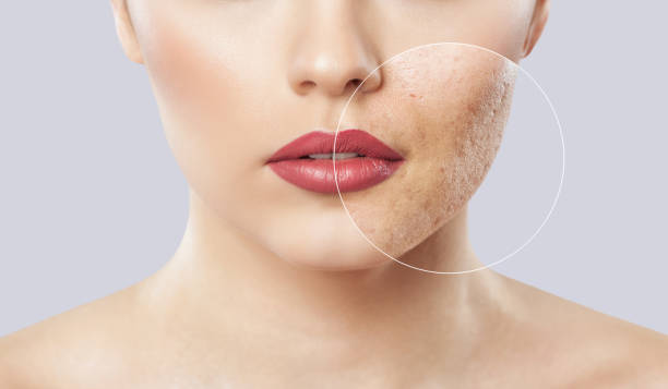 una jovencita con problemas de piel. foto antes y después del tratamiento para el acné. - cuidado de la piel fotos fotografías e imágenes de stock