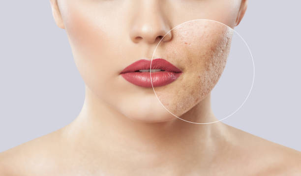 una ragazza con una pelle problematica. foto prima e dopo il trattamento per l'acne. - facial mask beauty beauty treatment women foto e immagini stock