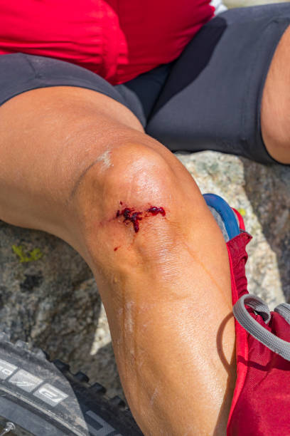 hurt knee from mountainbiking - mountain drop europe switzerland imagens e fotografias de stock