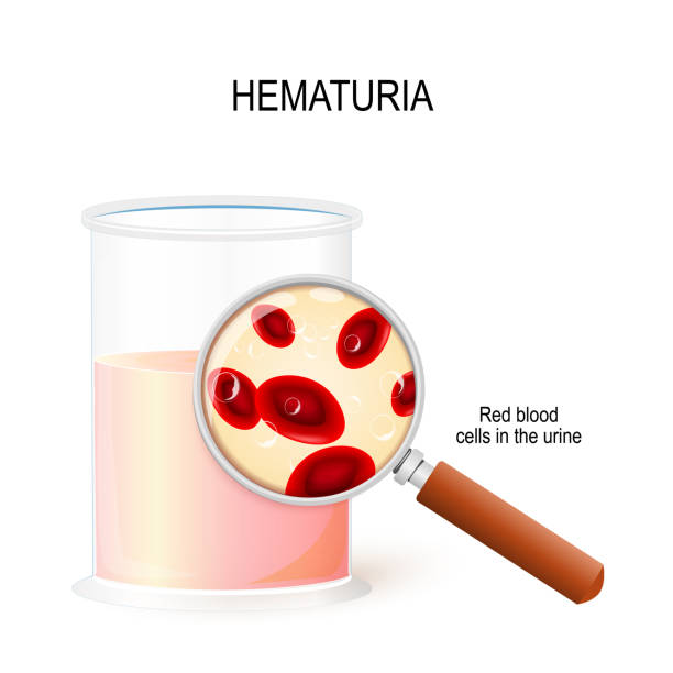 혈 뇨.  소변을 돋보기와 비 커. 붉은 혈액 세포의 근접 촬영 - glomerulus stock illustrations