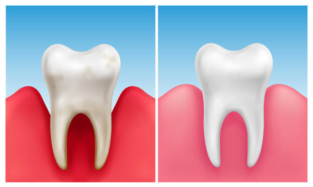 wektorowa ilustracja choroby dziąseł - zapalenie przyzębia w porównaniu ze zdrowym białym zębem - human teeth gums dental hygiene inflammation stock illustrations